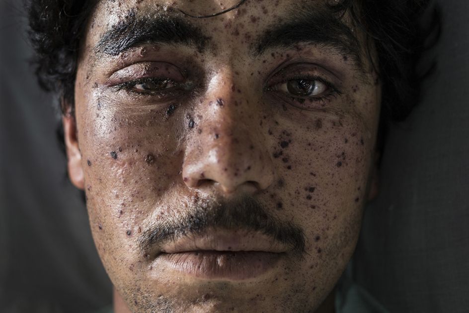 Paula Bronstein for The Cost of War | Recipient of the Getty Images Grant for Editorial Photography 2017