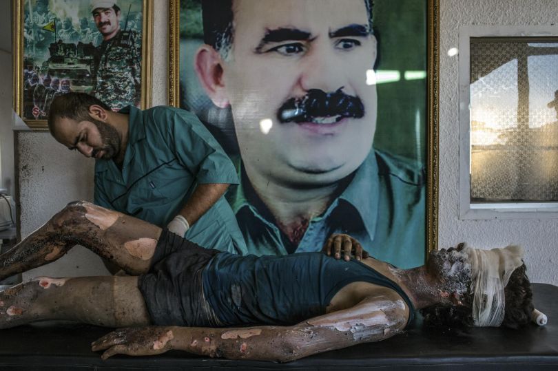 General News, first prize singles: A doctor rubs ointment on the burns of Jacob, a 16-year-old Islamic State fighter, in front of a poster of Abdullah Ocalan, the jailed leader of the Kurdistan Workers' Party, at a Y.P.G. hospital compound on the outskirts of Hasaka, Syria. Mauricio Lima.